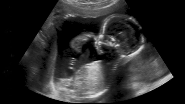 Ultrasound image